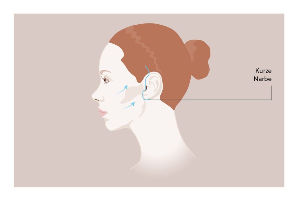 Illustration Mini-Facelift: kurze Schnittführung am Ohr und Zugrichtung