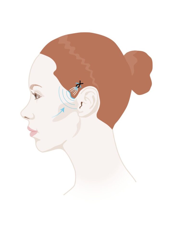 Illustration One-Stitch-Facelift: kleiner Schnitt im Schläfenbereich und Zugrichtung