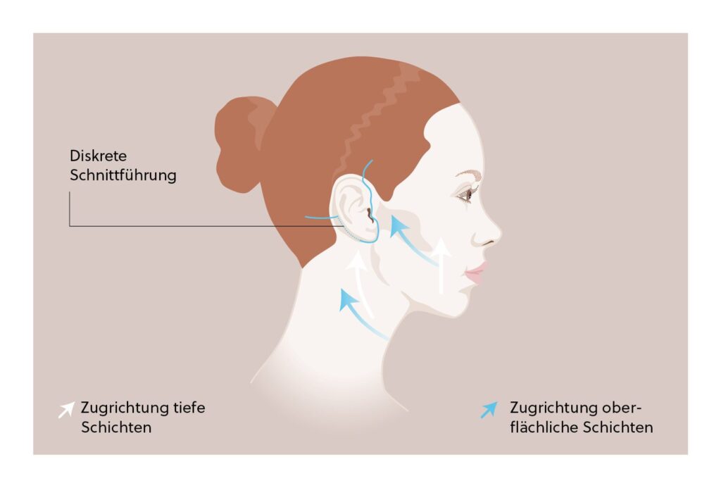 Illustration SMAS-Facelift: diskrete Schnittführung und Zugrichtung der tiefen und oberflächlichen Schichten