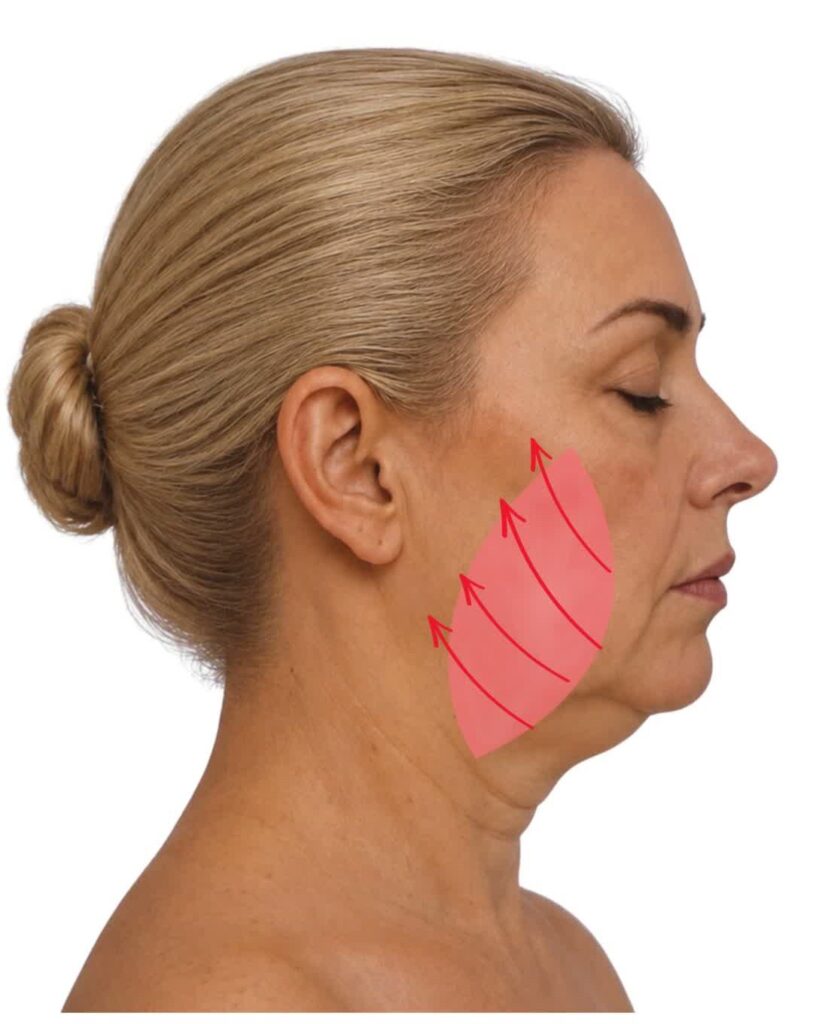 Deep Plane Facelift: zentral bzw. medial basierte Präparation in Richtung Nasolabialfalte und vertikal orientierte Repositionierung